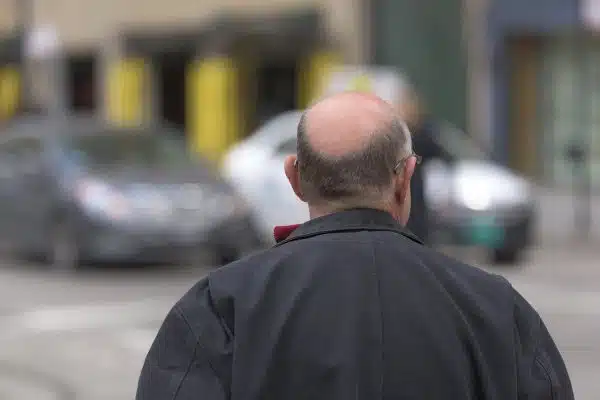 Quelles sont les différentes techniques de greffe pour les cheveux ?