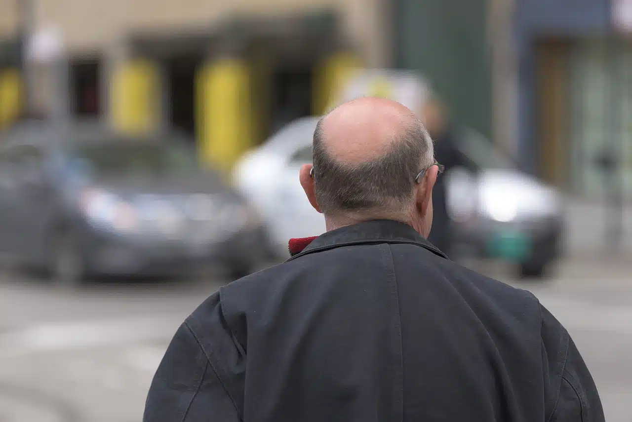 Quelles sont les différentes techniques de greffe pour les cheveux ?