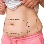 Eliminez vos complexes grâce à l'abdominoplastie les bienfaits d'une silhouette remodelée