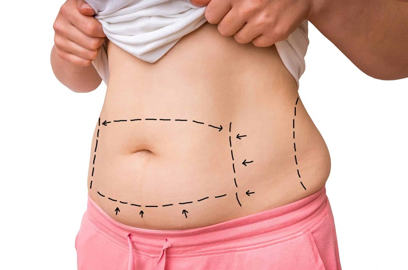 Eliminez vos complexes grâce à l'abdominoplastie les bienfaits d'une silhouette remodelée